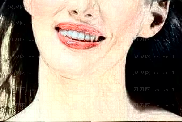 假体垫下巴多久消肿?假体垫下巴多久可以化妆