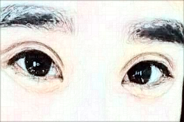 无锡切开双眼皮擅长医生有哪些