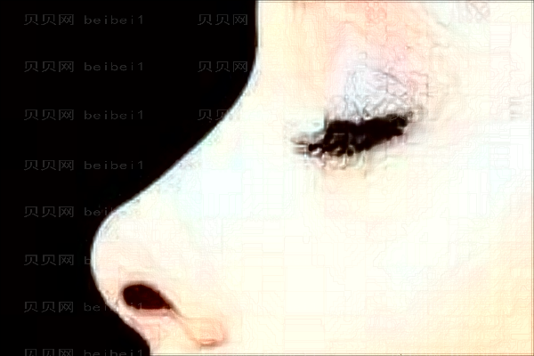 无锡去鼻唇沟比较好的医生是哪些