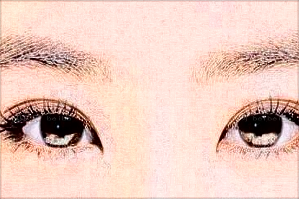 常州柏美内切去眼袋谁做得好?