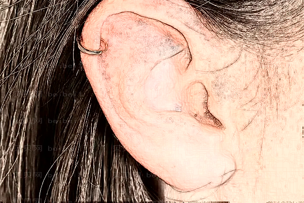 全耳再造手术需要多长时间？
