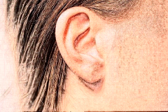 全耳再造有没有后遗症？