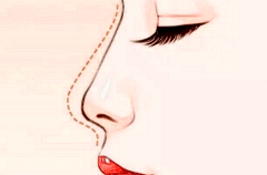 鼻中隔软骨延长鼻小柱能维持多久？