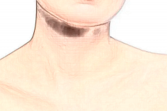 自体脂肪除颈纹有哪些并发症？