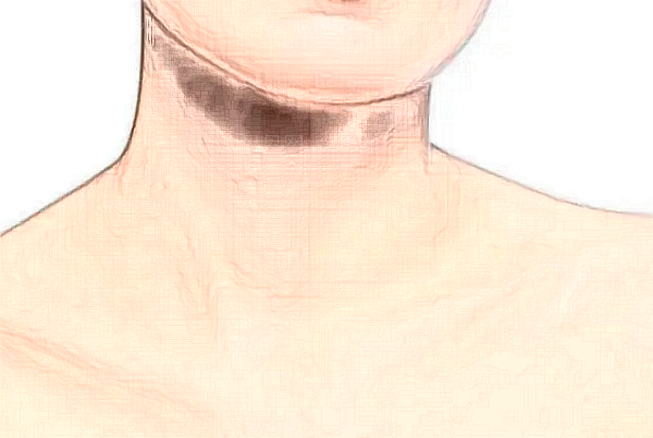 自体脂肪除颈纹有哪些并发症？