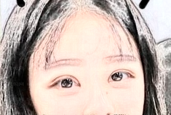 北京丽都射频去鱼尾纹好不好？