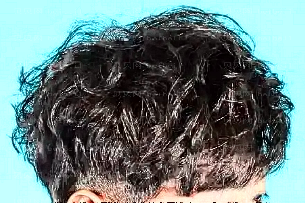 成都恒博自体毛发移植怎么样?