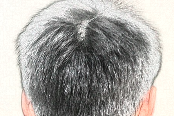 成都恒博鬓角移植王涛医生怎么样?