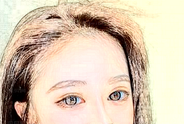 重庆华美激光去眼袋怎么样?