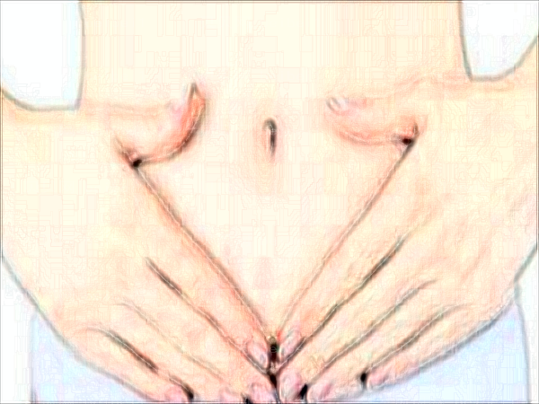 东莞伊然腹部吸脂郭永强医生怎么样？