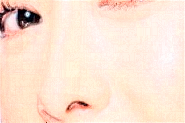 珠海可玫尔微晶磨削去法令纹贺鑫医生好不好?