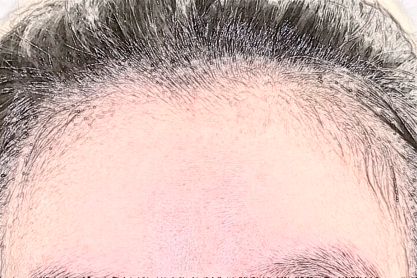 上海中瀛去眉间纹好不好？