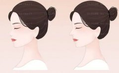 绵阳矫正短鼻好的医院名单在这里