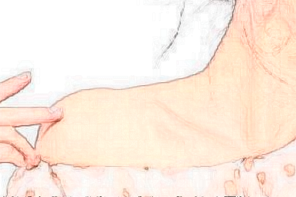 重庆华美冷冻法去腋臭好不好?