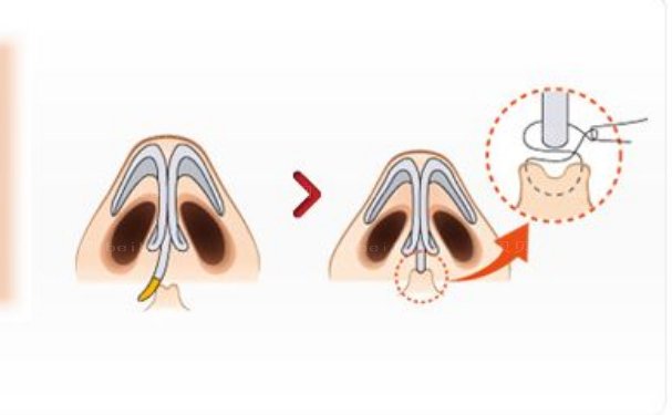 青岛鼻翼缩小哪个医院能做