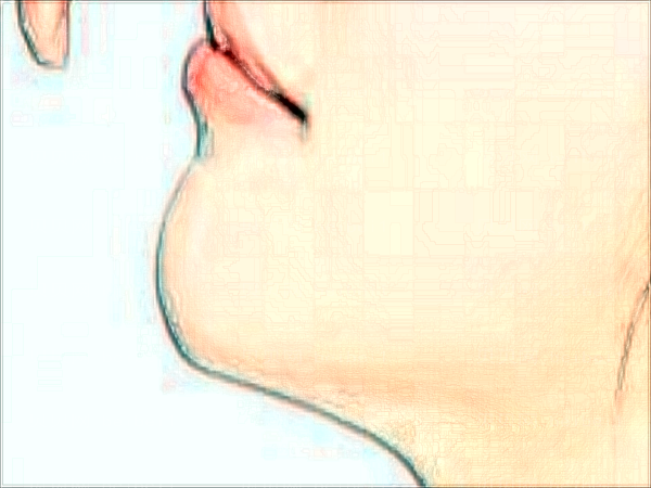 北京米扬丽格激光调节痤疮做的怎么样