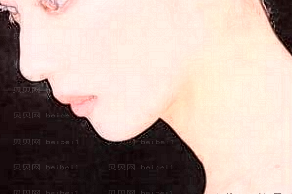 上海伊莱美聚左旋乳酸除皱推荐医生