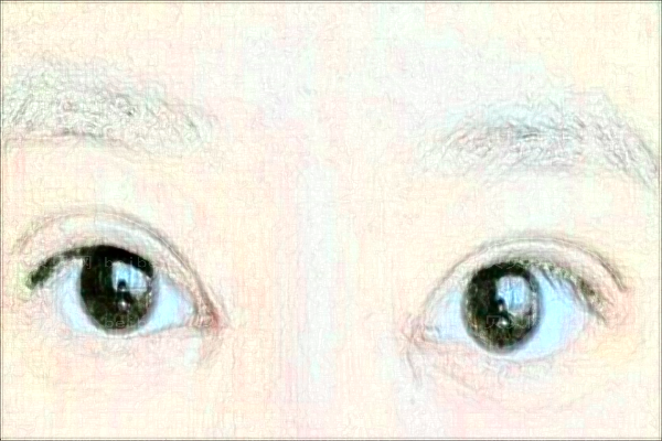 西安艾薇美玻尿酸垫眉弓口碑好不好