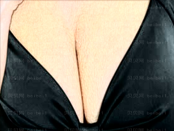 杭州格莱美吸脂去副乳实力如何