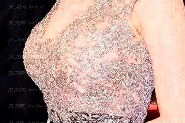 驻马店缔莱美去副乳失败修复哪个医生做得好