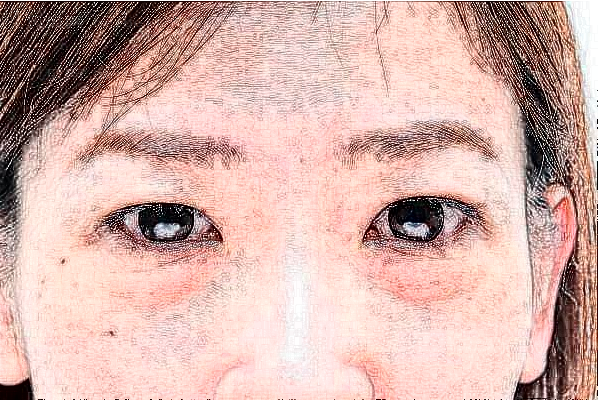 西安女子医院超声法去黑眼圈医生介绍