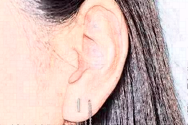 长沙艾缇自体脂肪丰耳垂正规吗