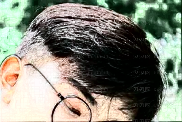 无锡爱思特鬓角移植口碑如何