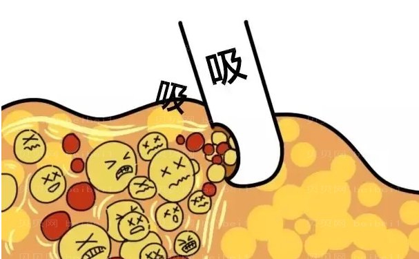 石家庄美莱吸脂哪个医生比较好