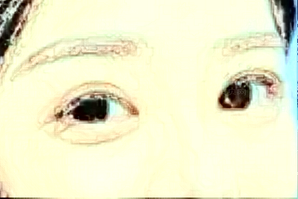 绵阳茗汇韩式开眼角正规吗