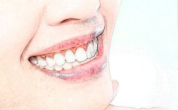 西安雁塔健齿象口腔全瓷牙种植几位医生能做