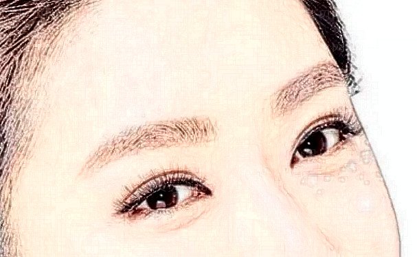北京画美任召磊做双眼皮怎么样？价格3000元起