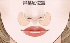 北京假体垫鼻基底医院展示，医生都有谁