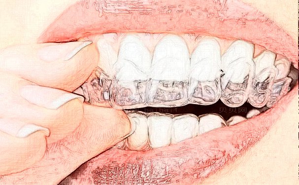 南京润玺口腔门诊隐形正畸价格多少？收费标准查询