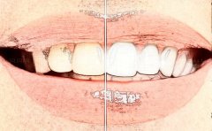 哈尔滨牙齿整形美容整形医生技术好吗+真实案例