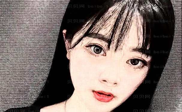 东莞华美詹慧祛除眼袋贵不贵?技术特点+案例展示