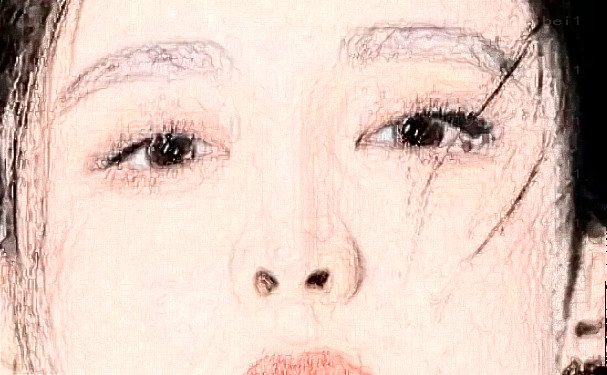 北京圣嘉荣吕玲玲埋线双眼皮风格介绍+具体反馈