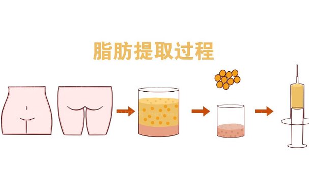 济南韩氏宋世鹏脂肪填充怎么样?手术案例+价格+技术评测