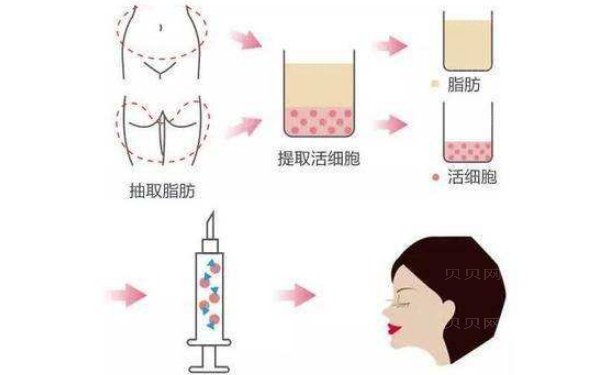 昆明艺星黄彪脂肪填充多少钱?手术价格表图一览
